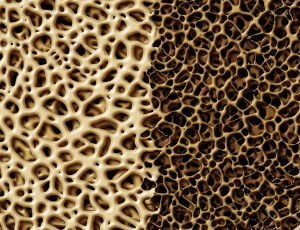 Bone with osteoperosis medical anatomy concept as a strong healthy and normal spongy tissue against unhealthy porous weak skeleton structure due to aging or illness.